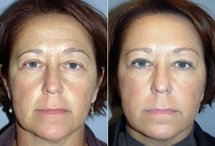 Botox before and after photo Eugene, OR.