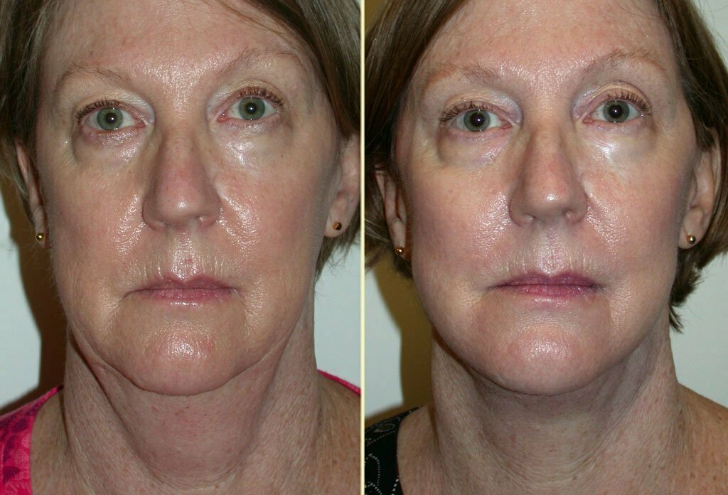 Facelift Patient 25