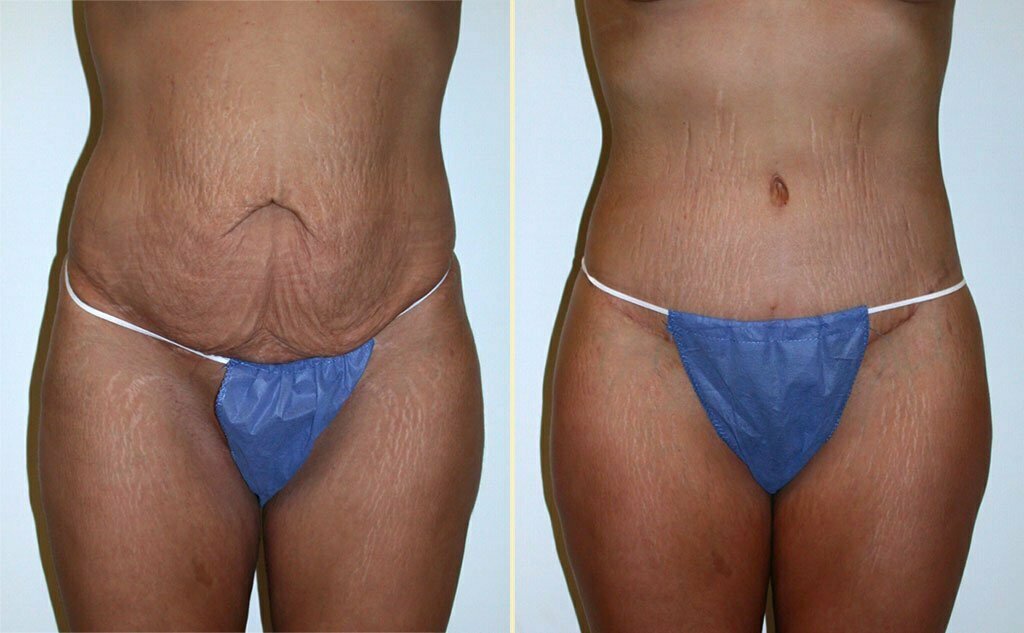 HLTA Tummy Tuck Patient 7