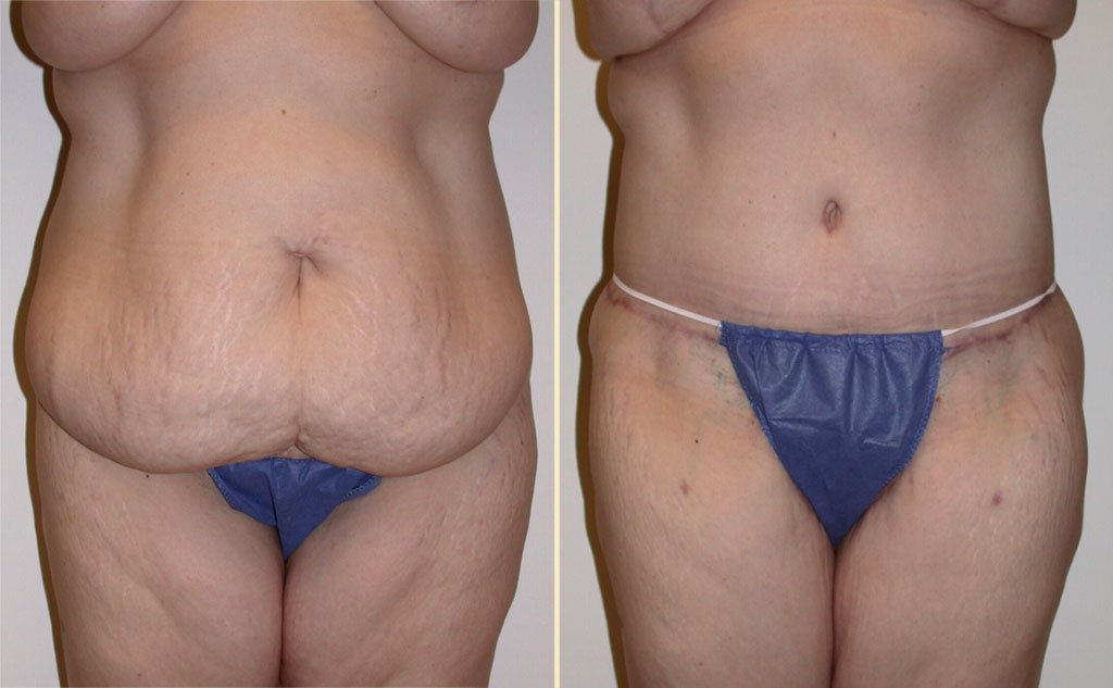 HLTA Tummy Tuck Patient 8