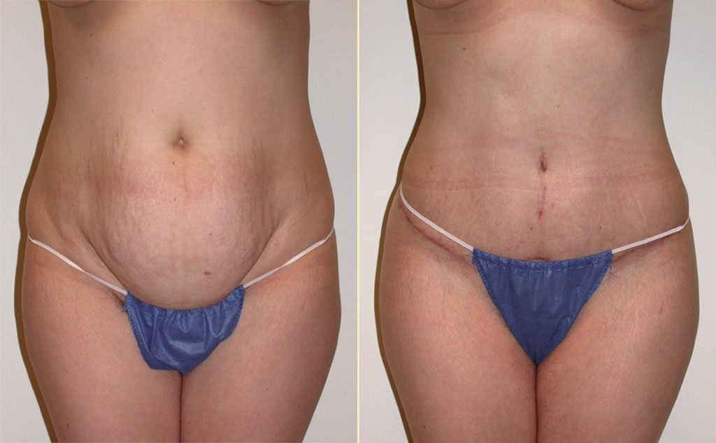 HLTA Tummy Tuck Patient 9