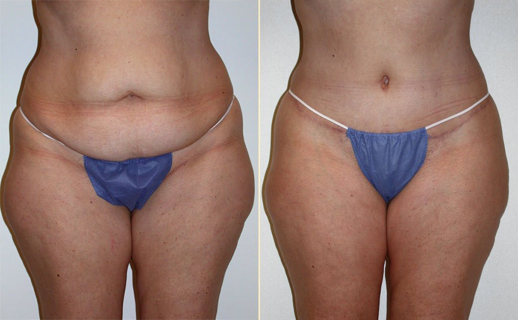 HLTA Tummy Tuck Patient 11