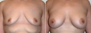 Breast Augmentation Patient 30