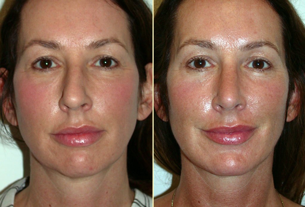 Rhinoplasty and Chin Augmentation Patient 18