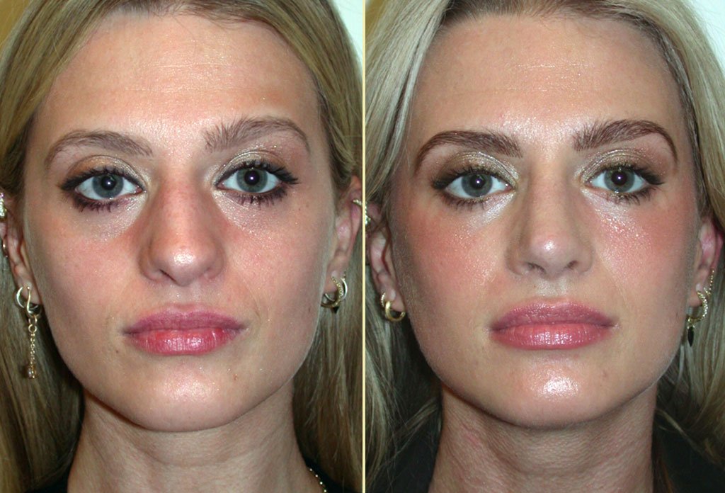 Rhinoplasty and Fat Injection to Cheeks Patient 20