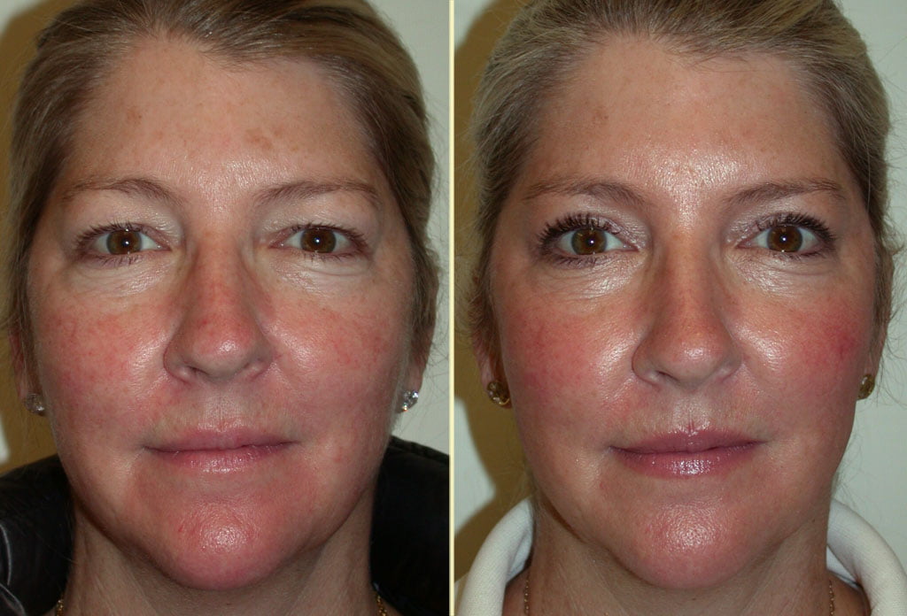 Brow Lift and Eyelid Lift