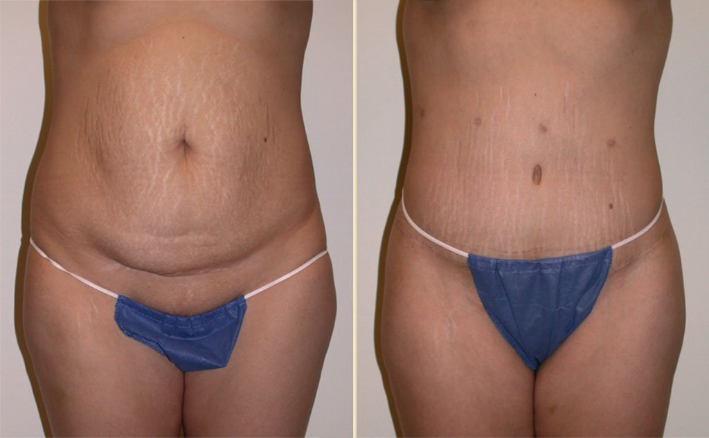 HLTA Tummy Tuck Patient 12