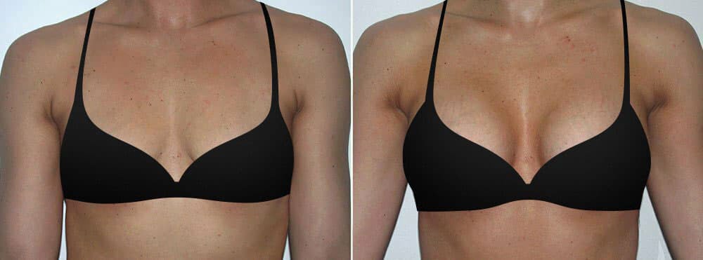 Andrew Trussler Breast Enhancement