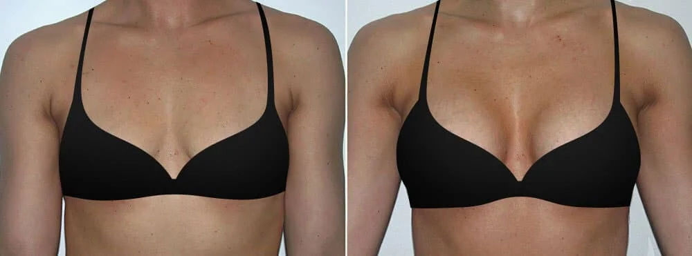 Breast Bra Before and After Image Gallery