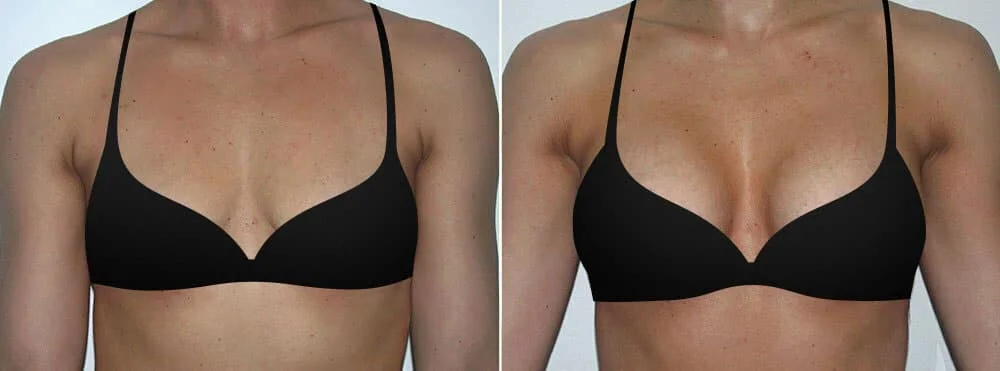 Dr Trussler Breast Augmentation Austin