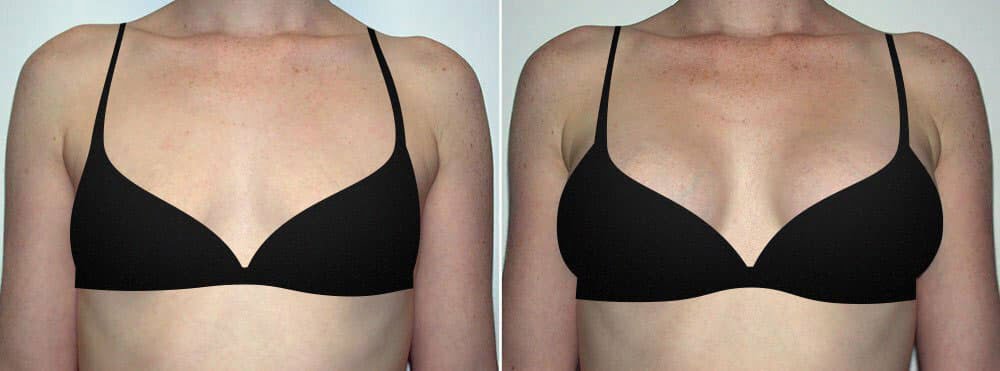 Photo of a woman before and after breast augmentation. Patients seeking breast augmentation, breast lift, breast reduction, or revision breast surgery should contact Movassaghi Plastic Surgery.