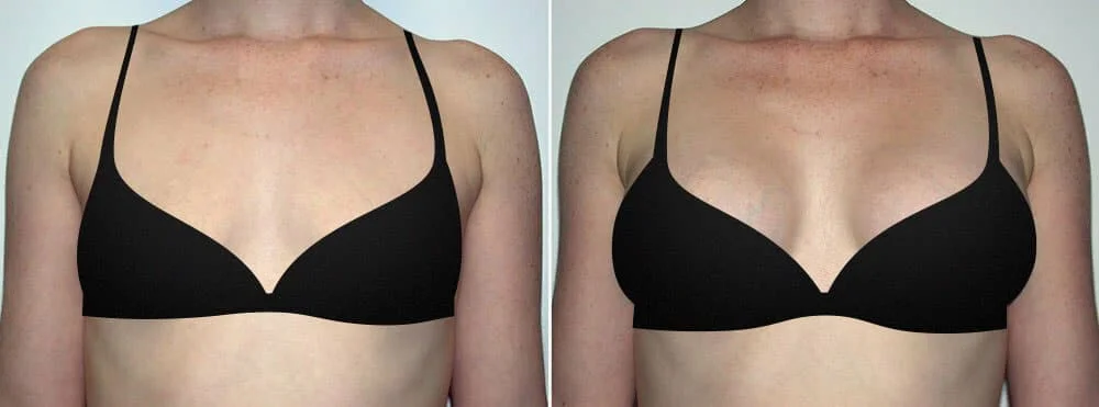 Breast augmentation vs breast lift - picking the right procedure