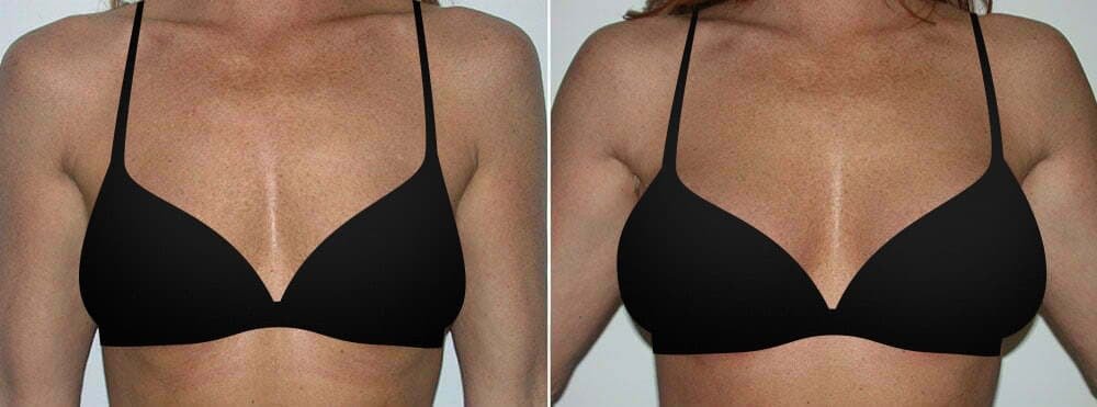 Photo of a woman before and after breast augmentation. Patients seeking breast augmentation, breast lift, breast reduction, or revision breast surgery should contact Movassaghi Plastic Surgery.