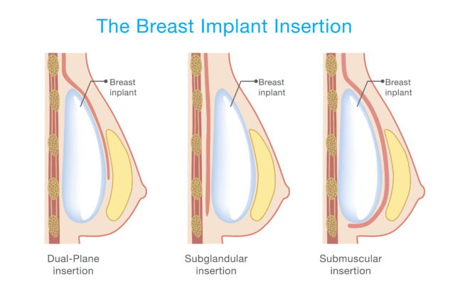 Breast implant placement options