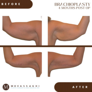 Photo of female patient before (top) and after (bottom) an upper arm lift, or brachioplasty.