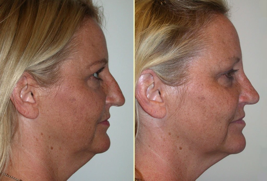 Rhinoplasty Patient 22