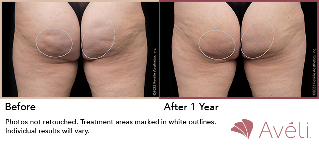 Cellulite reduction results after Aveli treatment reveal smoother buttocks. Treat cellulite with Aveli, an FDA-cleared device that releases fibrous septa beneath the skin