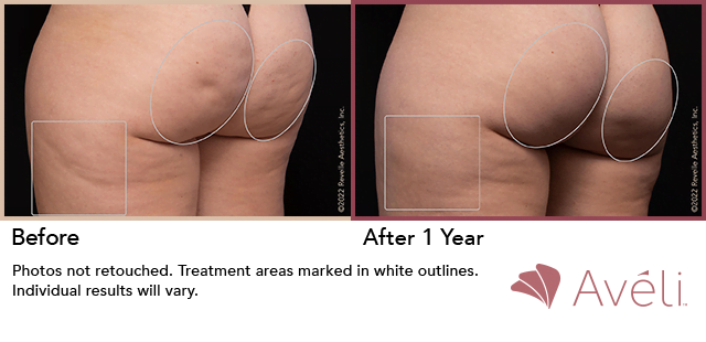 A woman's buttocks before and after Aveli cellulite treatment. Aveli cellulite therapy is inserted beneath the skin to release the cellulite dimples.