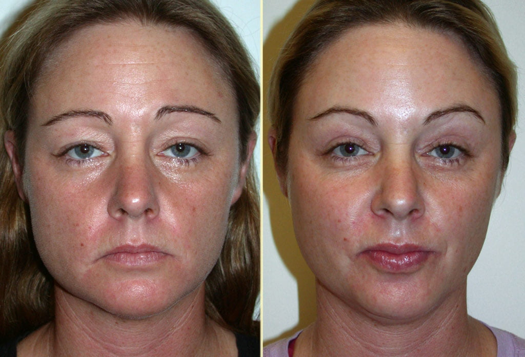 Brow Lift and Eyelid Lift