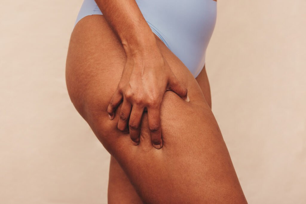 Woman touching her thigh after cellulite reduction treatment