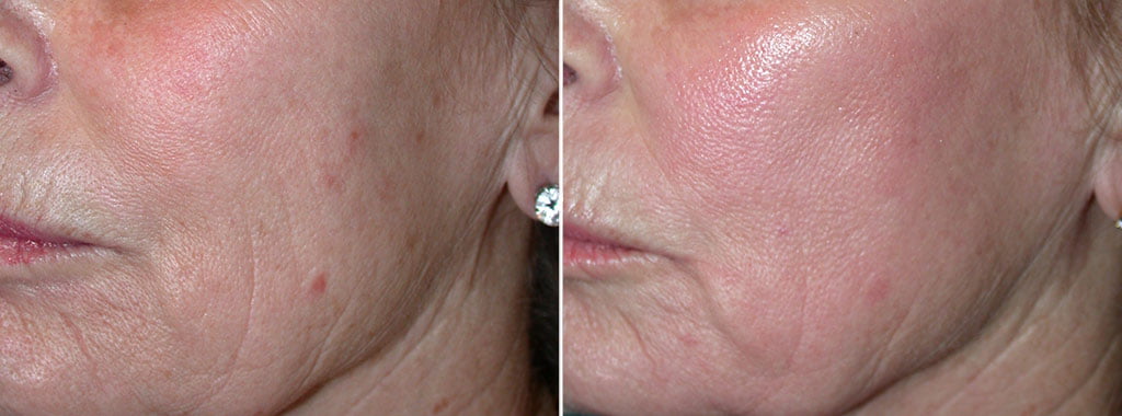 FX Laser Skin Resurfacing Patient 4