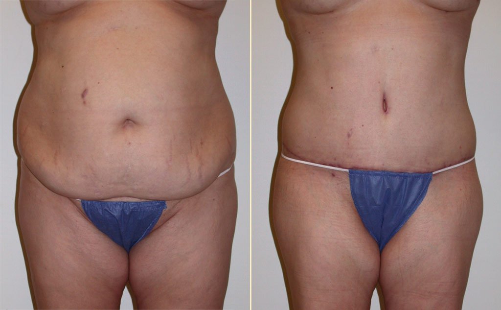 HLTA Tummy Tuck Patient 13