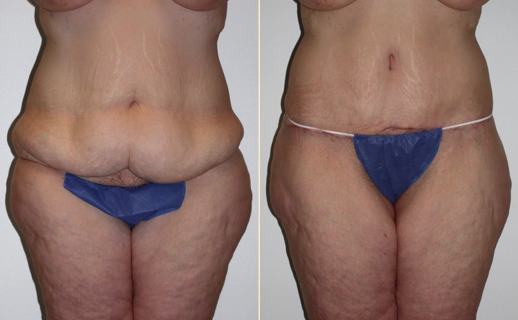 HLTA Tummy Tuck Patient 14