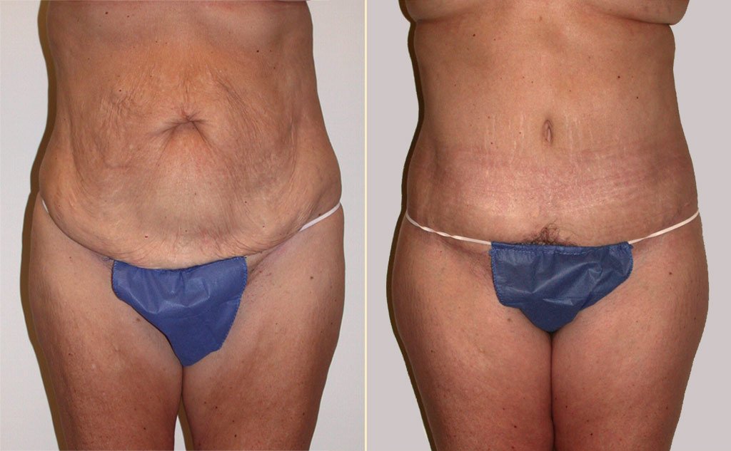 HLTA Tummy Tuck Patient 15