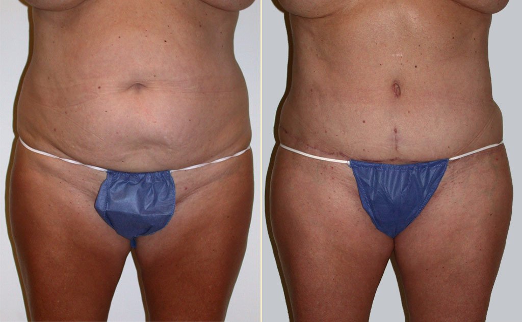 HLTA Tummy Tuck Patient 16