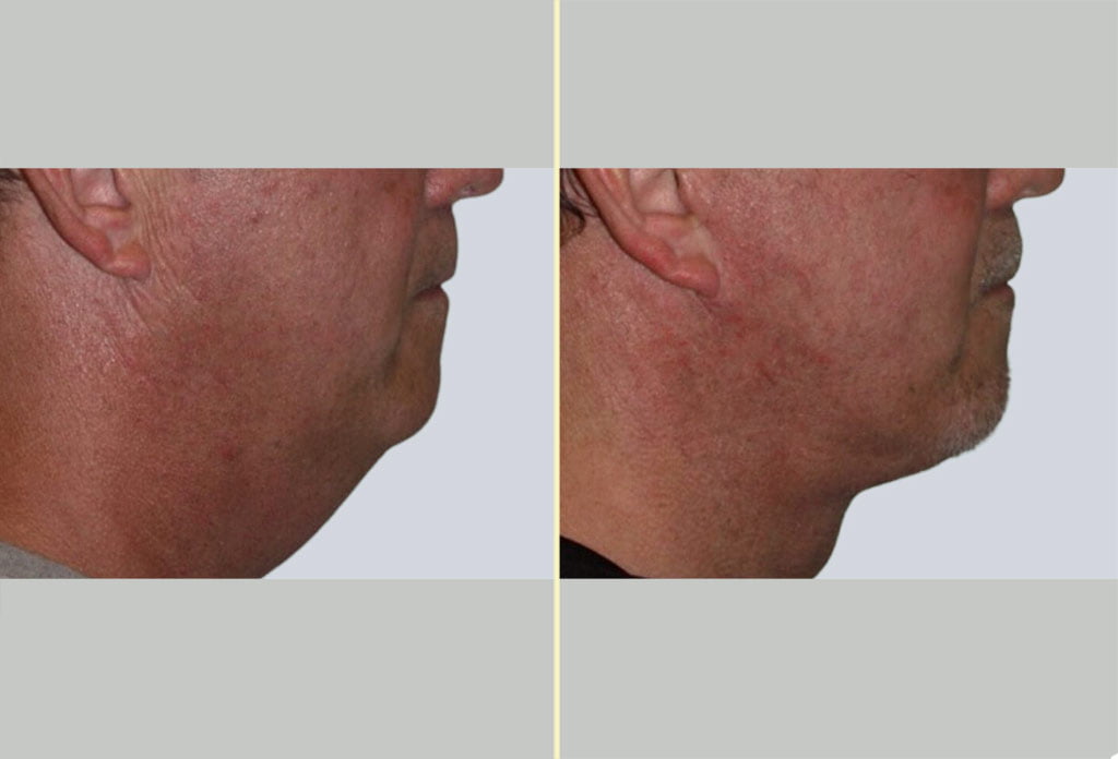 Male Neck Lift Patient 01