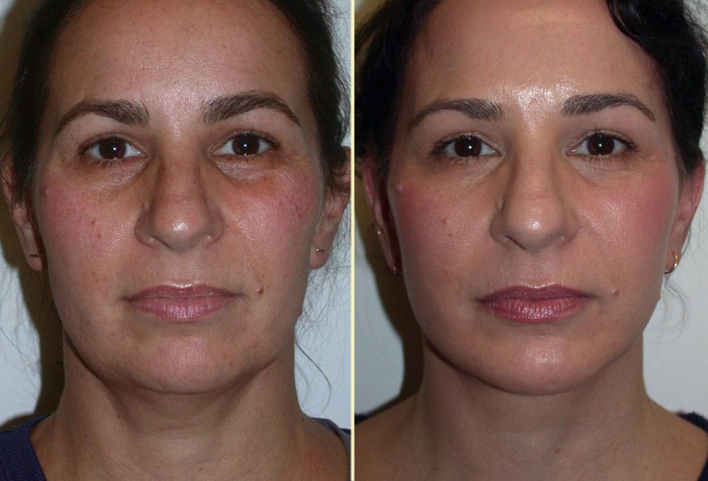 Facelift Patient 35