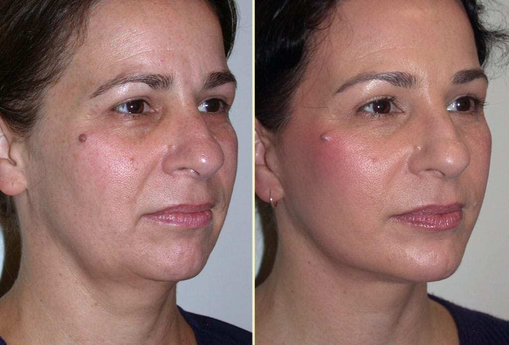 facelift-browlift-chinaug-31174-29414b-movassaghi