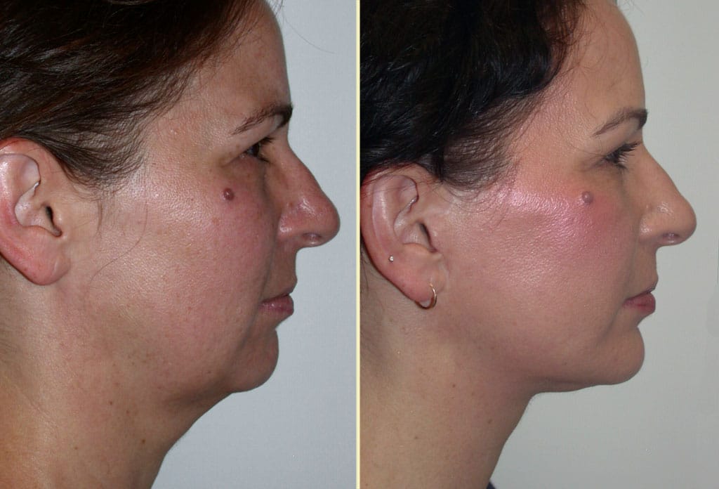 facelift-browlift-chinaug-31174-29414c-right-movassaghi