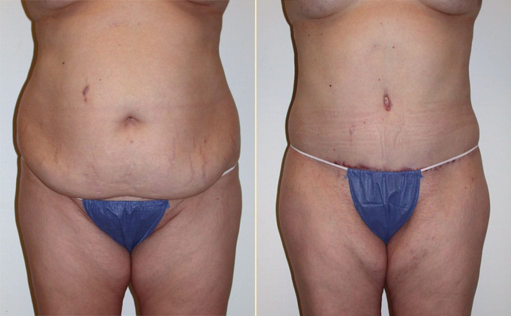 Tummy Tuck 38
