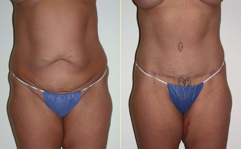 Tummy Tuck 36