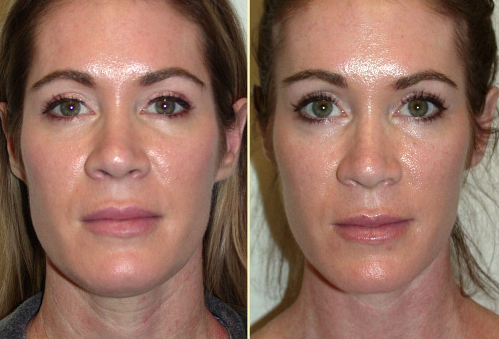 Neck Lift and Brow Lift