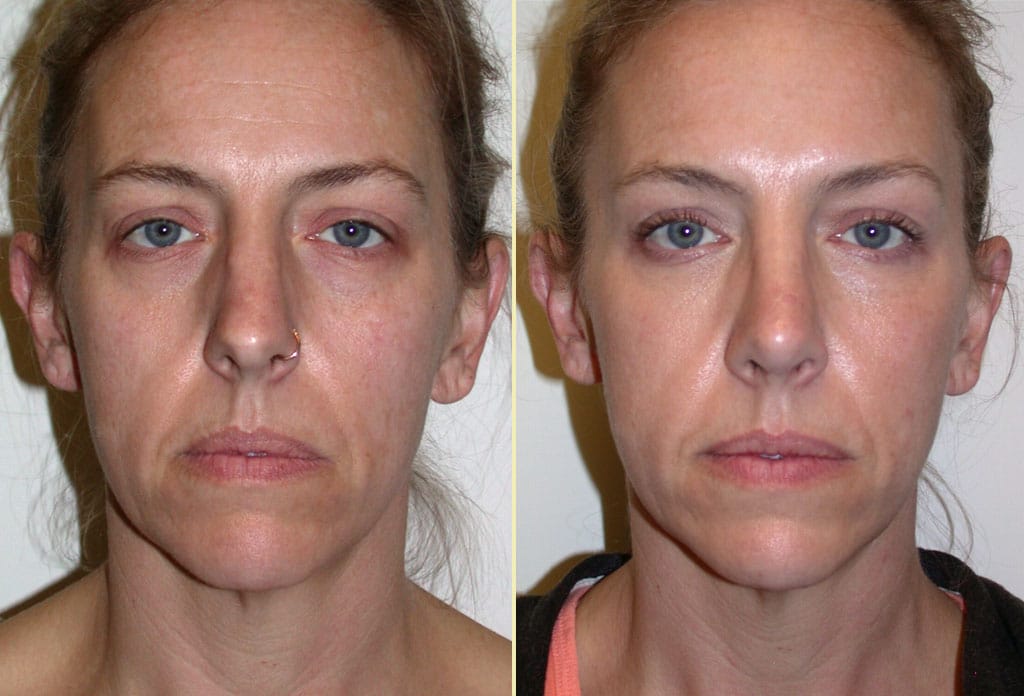 Rhinoplasty Patient 25
