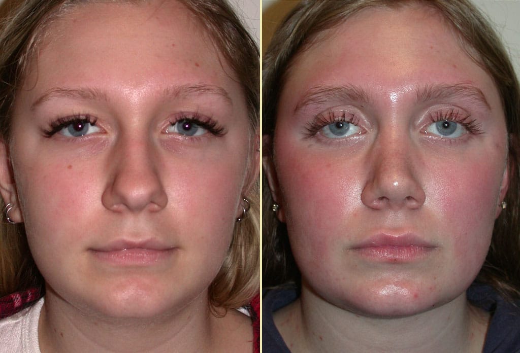 Rhinoplasty & Neck Lift Patient 26