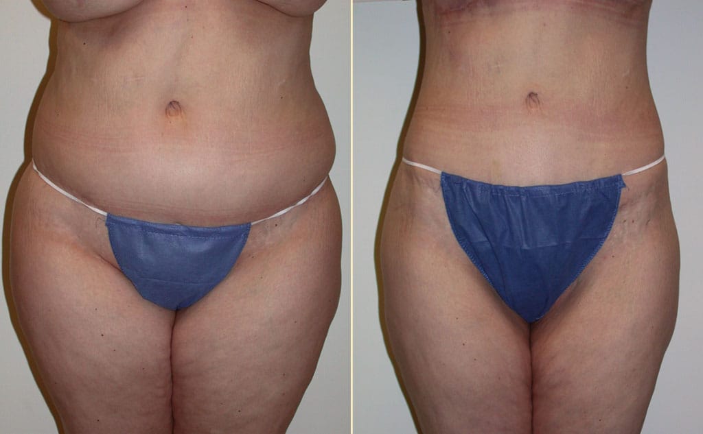 Reverse Tummy Tuck 35