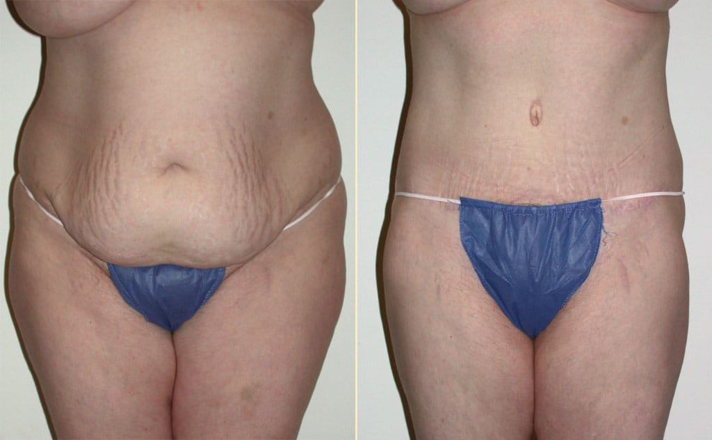 Tummy Tuck 37