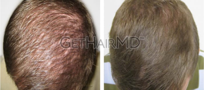 Male patient shown before and after hair restoration with GetHairMD