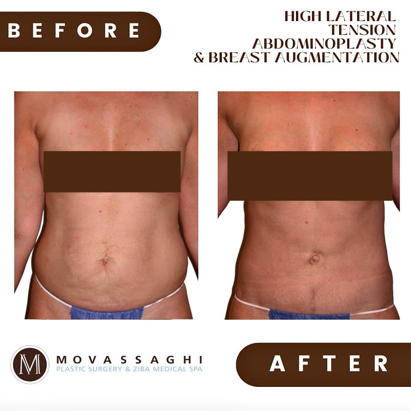 Before and after a mommy makeover with high lateral tension abdominoplasty and breast augmentation with Eugene plastic surgeon Dr. Kiya Movassaghi