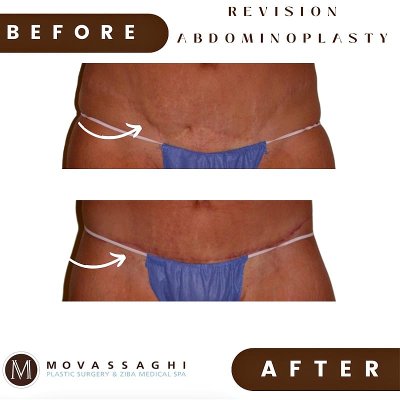Before and after revision abdominoplasty with Dr. Kiya Movassaghi in Eugene, OR