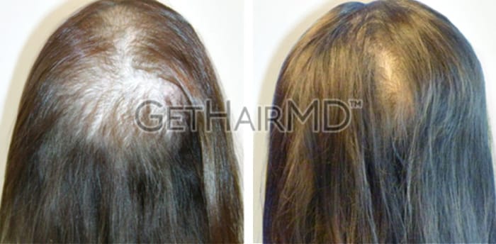 before-after-get-hair-md-female-hair-restoration-2
