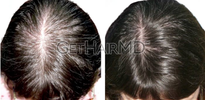 before-after-get-hair-md-female-hair-restoration-2