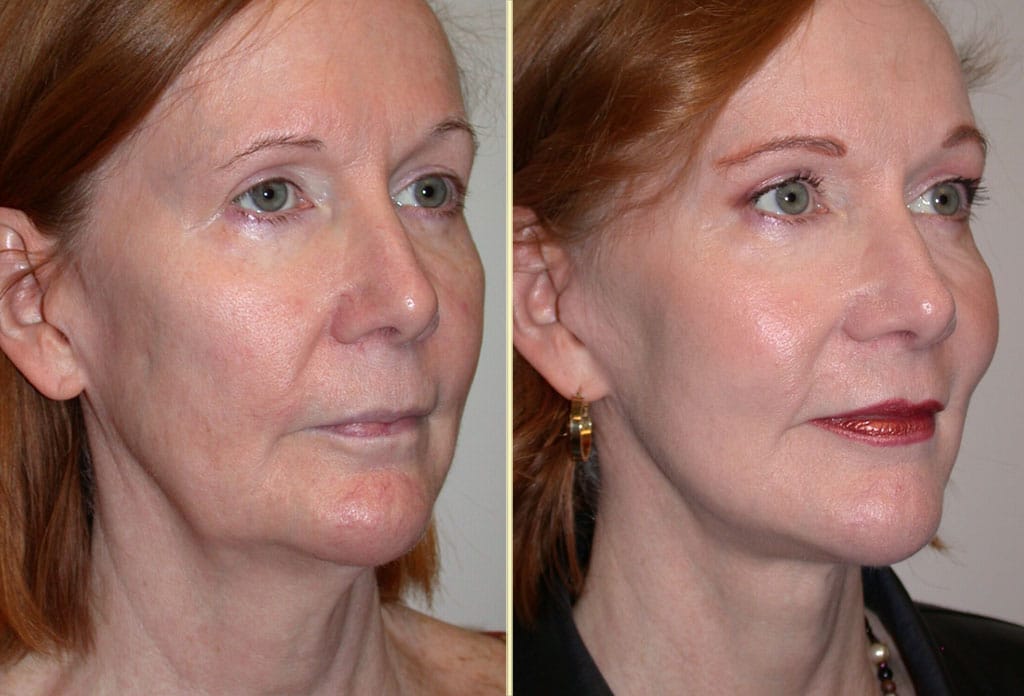 facelift-29914-30226b-movassaghi