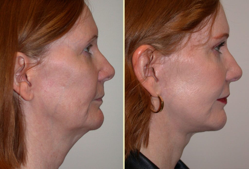 facelift-29914-30226c-movassaghi