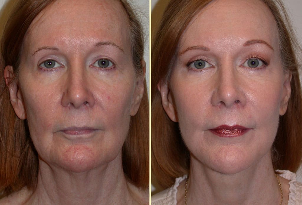Facelift Patient 36