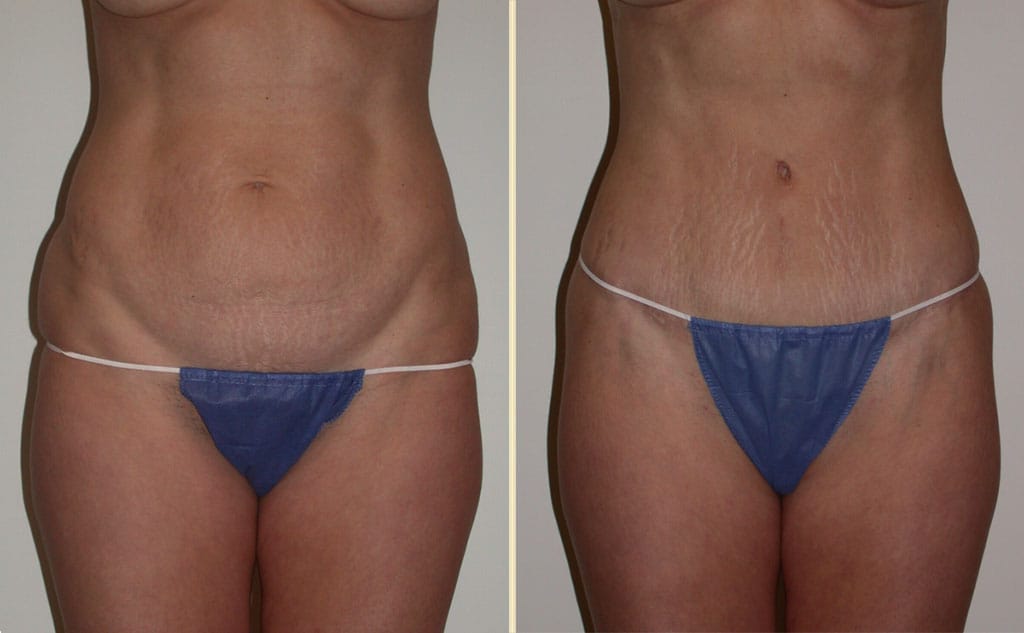 Tummy Tuck 39