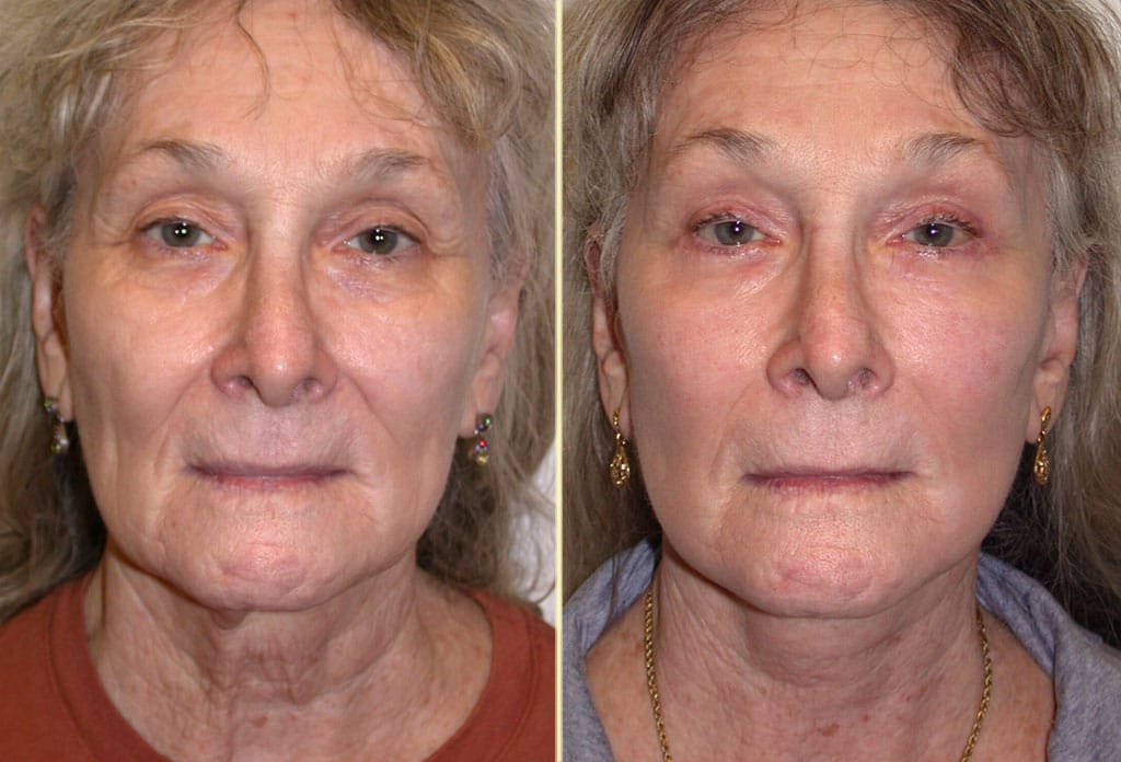 Face Combined Procedures